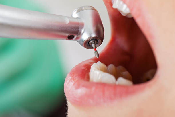 Tooth Infection Emergency Dentist in ID